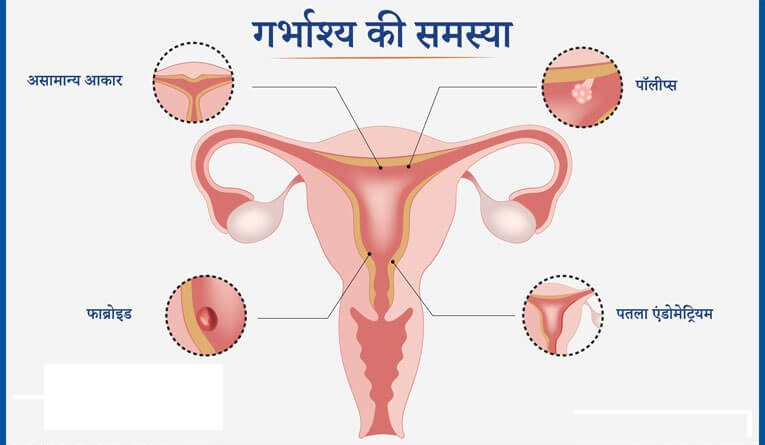 गर्भाशय खराब होने के लक्षण जानकारी | NovaKhabar