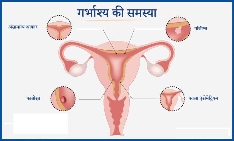 गर्भाशय खराब होने के लक्षण जानकारी | NovaKhabar